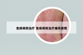 免疫吸附治疗 免疫吸附治疗痛风原理