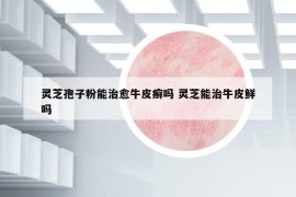 灵芝孢子粉能治愈牛皮癣吗 灵芝能治牛皮鲜吗