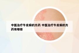 中医治疗牛皮癣的方药 中医治疗牛皮癣的方药有哪些