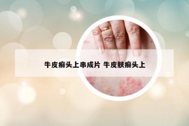 牛皮癣头上串成片 牛皮肤癣头上