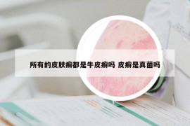 所有的皮肤癣都是牛皮癣吗 皮癣是真菌吗