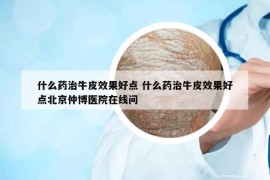 什么药治牛皮效果好点 什么药治牛皮效果好点北京仲博医院在线问