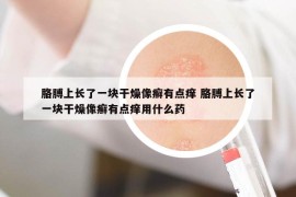 胳膊上长了一块干燥像癣有点痒 胳膊上长了一块干燥像癣有点痒用什么药