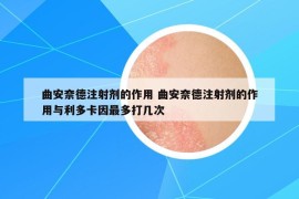 曲安奈德注射剂的作用 曲安奈德注射剂的作用与利多卡因最多打几次