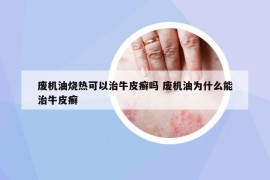 废机油烧热可以治牛皮癣吗 废机油为什么能治牛皮癣