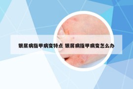 银屑病指甲病变特点 银屑病指甲病变怎么办