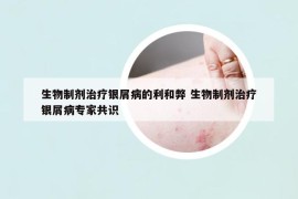 生物制剂治疗银屑病的利和弊 生物制剂治疗银屑病专家共识