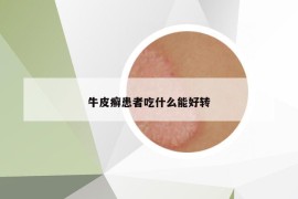 牛皮癣患者吃什么能好转