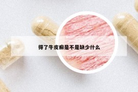 得了牛皮癣是不是缺少什么