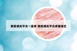 银屑病关节炎一直疼 银屑病关节炎疼痛难忍
