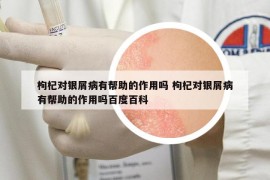 枸杞对银屑病有帮助的作用吗 枸杞对银屑病有帮助的作用吗百度百科