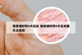 银屑病好转6大征兆 银屑病好转6大征兆图片点滴状