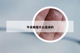 牛皮癣是什么造成的