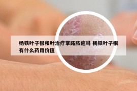 杨铁叶子根和叶治疗掌跖脓疱吗 杨铁叶子根有什么药用价值