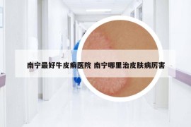 南宁最好牛皮癣医院 南宁哪里治皮肤病厉害