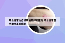 烟台哪家治疗银屑病最好的医院 烟台哪家医院治疗皮肤病好