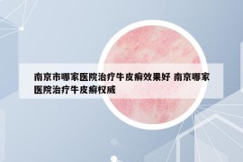 南京市哪家医院治疗牛皮癣效果好 南京哪家医院治疗牛皮癣权威