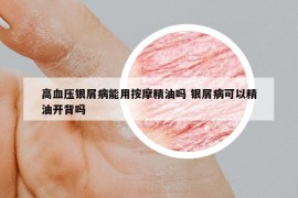 高血压银屑病能用按摩精油吗 银屑病可以精油开背吗