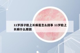 11岁孩子脸上长癣是怎么回事 11岁脸上长癣什么原因