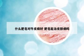 什么肥皂对牛皮癣好 肥皂能治皮肤病吗