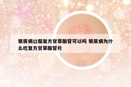 银屑病口服复方甘草酸苷可以吗 银屑病为什么吃复方甘草酸苷片