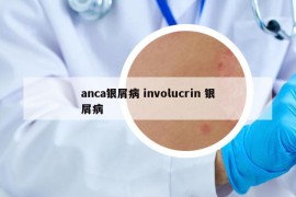 anca银屑病 involucrin 银屑病