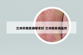 兰州市银屑病哪家好 兰州银屑病医院