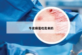 牛皮癣是吃出来的