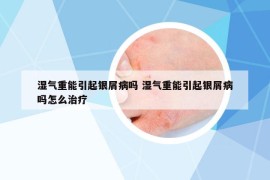 湿气重能引起银屑病吗 湿气重能引起银屑病吗怎么治疗