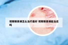 初期银屑病怎么治疗最好 初期银屑病能治愈吗