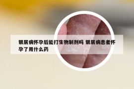 银屑病怀孕后能打生物制剂吗 银屑病患者怀孕了用什么药