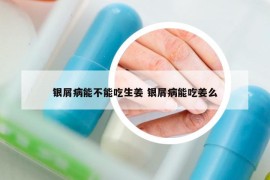 银屑病能不能吃生姜 银屑病能吃姜么