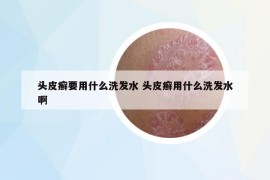 头皮癣要用什么洗发水 头皮癣用什么洗发水啊