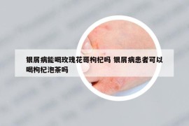 银屑病能喝玫瑰花哥枸杞吗 银屑病患者可以喝枸杞泡茶吗