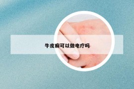 牛皮癣可以做电疗吗