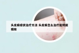 头皮癣症状治疗方法 头皮癣怎么治疗能彻底根除