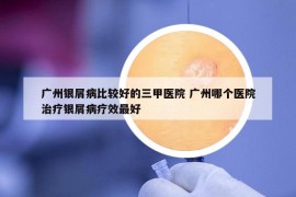 广州银屑病比较好的三甲医院 广州哪个医院治疗银屑病疗效最好