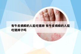 有牛皮病癣的人能吃猪蹄 有牛皮病癣的人能吃猪蹄子吗