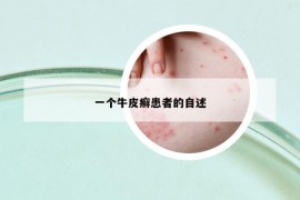 一个牛皮癣患者的自述