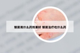 银屑用什么药效果好 银屑治疗吃什么药