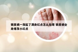 银屑病一夜起了满身红点怎么处理 银屑病全身爆发小红点