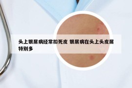 头上银屑病经常扣死皮 银屑病在头上头皮屑特别多
