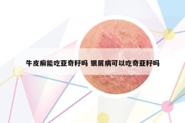 牛皮癣能吃亚奇籽吗 银屑病可以吃奇亚籽吗