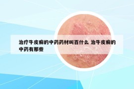治疗牛皮癣的中药药材叫百什么 治牛皮癣的中药有那些