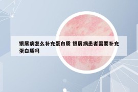 银屑病怎么补充蛋白质 银屑病患者需要补充蛋白质吗