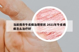当前我市牛皮癣治理现状 2021年牛皮病癣怎么治疗好