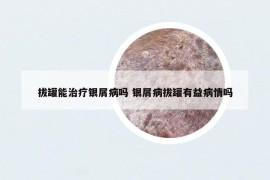 拔罐能治疗银屑病吗 银屑病拔罐有益病情吗