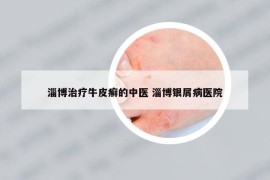 淄博治疗牛皮癣的中医 淄博银屑病医院