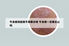 牛皮癣到底需不需要忌嘴 牛皮癣一定要忌口吗