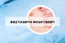 藿香正气水治脚气吗 碘伏治好了我的脚气